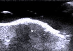 Squamous cell carcinoma (SCC) with irregular borders showing abundant Doppler flow, indicating the presence of neovascularization.
