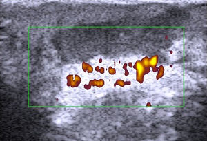 Hidradenitis. Irregular hypoechoic area at the dermal-subcutaneous junction with increased perilesional flow.