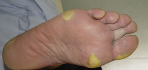 Hand-foot skin reaction. Hyperkeratotic lesions on the sole of the foot, with the formation of calluses and, in some cases, of superficial blisters on an erythematous base. Figure courtesy of Dr Tuneu and Dr López Pestaña of Hospital Donostia, San Sebastian, Spain.