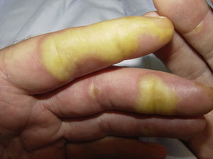 Hand-foot skin reaction. Hyperkeratotic lesions on the flexor surfaces of the fingers, with the formation of calluses and, in some cases, of superficial blisters on an erythematous base. The characteristic peripheral erythematous halo can be seen. Figure courtesy of Dr Tuneu and Dr López Pestaña of Hospital Donostia, San Sebastian, Spain.