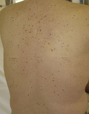 Eruptive melanocytic lesions in a patient treated with sorafenib. Figure courtesy of Dr Tuneu and Dr López Pestaña of Hospital Donostia, San Sebastian, Spain.