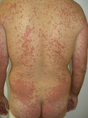 Skin eruption presenting as a skin rash/toxic dermatitis in a patient on treatment with sorafenib. Figure courtesy of Dr Tuneu and Dr López Pestaña of Hospital Donostia, San Sebastian, Spain.