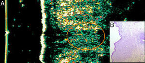 Case 5. Woman aged 71 years with basal cell carcinoma on her back. A, Ultrasound image (20Mhz) of the lesion showing a poorly defined subepidermal oval hypoechoic structure, from which arises a poorly defined hypoechoic extension that invades the underlying dermis and is compatible with infiltration. B, Histologic image of the lesion (hematoxylin-eosin, original magnification×4). The nests of basaloid cells infiltrating the underlying dermis are compatible with infiltrative basal cell carcinoma.