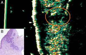 Case 6. Woman aged 50 with basal cell carcinoma on her chest. A, Ultrasound image (20Mhz) of the lesion showing a flattened subepidermal hypoechoic structure, underneath which we can see another poorly defined hypoechoic formation that invades the underlying dermis until it reaches the dermal-epidermal junction and is suggestive of inflammation (orange circle). B, Histologic image of the lesion (hematoxylin-eosin, original magnification×10) showing the infiltrative component invading the underlying dermis.
