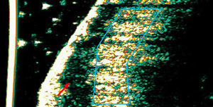 Case 8. Man aged 74 years with basal cell carcinoma on the parietal scalp. A, Ultrasound image (20Mhz) of the lesion showing a flattened subepidermal hypoechoic structure with no hypoechoic extensions invading the underlying dermis suggestive of inflammation (red arrow). The area highlighted in blue shows intense hyperechogenicity in the dermis representing intense fibrosis. This may be the reason why tumor infiltration was not detected.