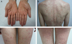 First bout of type I pityriasis rubra pilaris. A, Waxy palmar keratoderma. B-D, Scaly, orange-red patches on the trunk and limbs with islands of sparing and marked follicular hyperkeratosis.