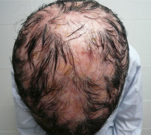 Second bout of type I pityriasis rubra pilaris. Large patches of scarring alopecia with follicular flaking and patchy perifollicular erythema that developed into atrophic pearly patches without erythema or scaling.