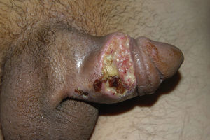 Ulcerated lesion of about 3cm diameter on the right lateral surface of the penile shaft.