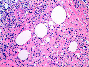 Photomicrograph showing the empty vacuoles at greater magnification. The histiocytes are also seen in greater detail and some multinucleated giant cells are present due to the foreign body reaction. Hematoxylin and eosin, original magnification×20.