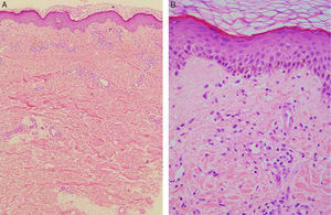 Histopathological features. (A and B) Moderate superficial perivascular inflammatory infiltrate composed of lymphocytes and numerous neutrophils in the dermis, with no signs of edema or vasculitis.