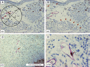 D2-40/Ki-67 double stain of melanoma preparations and of a lymph node metastasis. A, Chalkley graticule. The points marked with red circles are considered positive. B, D2-40–positive lymph vessels in the primary tumor and numerous D2-40–negative blood vessels occurring in a hot spot in the lower part of the image (arrows). C, Melanoma sentinel lymph node metastasis with D2-40–positive lymph vessels (arrow). D, Melanoma sentinel lymph node metastasis at higher magnification. Proliferating lymph vessels can be seen. The walls of the vessels are clearly positive for D2-40 (cytoplasmic pattern, fast red chromogen, Dako) and the nucleus is positive for Ki-67 (nuclear pattern, DAB chromogen, Dako [arrow]).