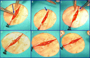 Surgical technique. See the description in the text.