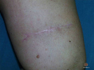 Scar from the excision of a melanoma on the anterior aspect of the right thigh 2 years after performing the vector-running subcutaneous suture. The same case is presented in the video.