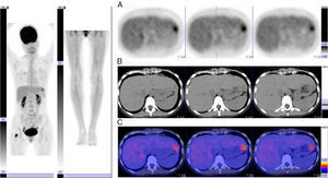 Axial PET/CT images showing PET images (A), CT images (B), and superimposed PET/CT images. Note the hypermetabolic focus in the left hepatic lobe and right femur indicative of metastasis in both locations. PET indicates positron emission tomography; CT, computed tomography.
