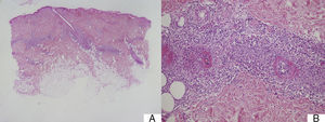 A, Mixed superficial and deep perivascular inflammation (panoramic view, hematoxylin-eosin, original magnification ×2). B, Higher magnification view of fibrinoid necrosis of vessel, perivascular inflammatory infiltrate, and nuclear dust or leukocytoclastia (hematoxylin-eosin, original magnification ×10).