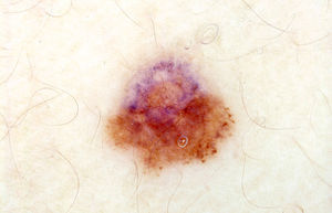 Dermoscopic image of a superficial spreading melanoma 4mm in diameter and 0.5mm thick. showing structural asymmetry (probable genetic instability), focal peripheral globules (proliferation), and gray pepper-like pattern in the upper third (regression).