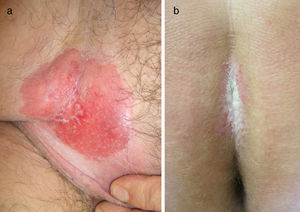 A, Case 1: Erythematous, exudative plaque measuring 10×12cm, with moderate infiltration and well-defined borders on the right groin corresponding to invasive extramammary Paget disease. B, Case 3: Erythematous plaque with a whitish exudate measuring 6×4cm, moderate infiltration, and well-defined borders in the gluteal cleft corresponding to extramammary Paget disease in situ.