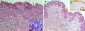 A, Case 9: infiltration of the epidermis with no involvement of the dermis by cells with abundant, eosinophilic cytoplasm and evident nucleoli (Paget cells) grouped in nests (hematoxylin-eosin, original magnification ×4). *Occasional formation of small glands (×20). B, Case 2: presence of Paget cells in the epidermis and dermis (hematoxylin-eosin, original magnification ×4). CK immunostaining with low- and high-molecular-weight keratins (AE1 and AE3) showing positivity in the epidermis, follicular epithelium, and (more intense) in Paget cells, with invasion of the reticular dermis by individual cells and small groups of cells (×4). CK indicates cytokeratin.