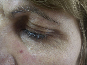 Poliosis, with affected eyelashes interspersed among normally pigmented eyelashes.
