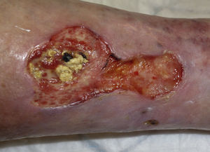 Right supramalleolar ulcer with extrusion of calcified material, prior to shock wave therapy. Largest diameter was 8cm, proximal width was 4.5cm, and distal width was 2.5cm.