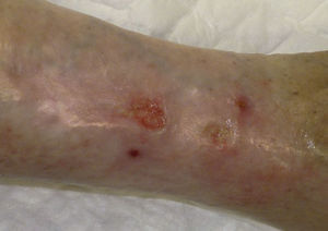 Leg ulcer region after 27 shock wave therapy sessions comprises a proximal ulcer measuring 1.2×0.9cm and a distal ulcer measuring 0.8×0.8cm.