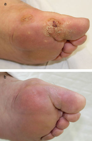 A. Plantar warts before treatment. B, Resolution of plantar warts after treatment with sinecatechins ointment.