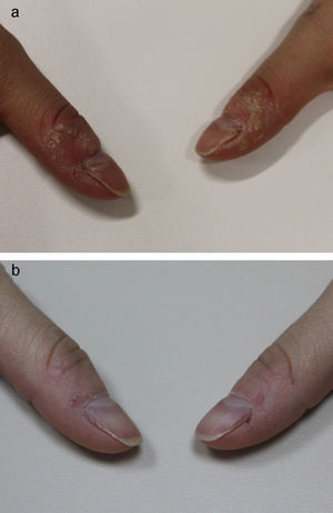 A. Periungual warts on several fingers, before treatment. B, Resolution of lesions after treatment.