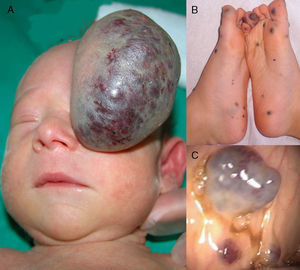 A, A large, pedunculated vascular tumor with superficial telangiectasias. The tumor had a blue-purpuric color centrally and was pale peripherally, similar to a rapidly involuting congenital hemangioma. B, Multiple bluish skin lesions on the feet, typical of blue rubber bleb nevus syndrome. C, Venous malformations in the gastrointestinal tract.