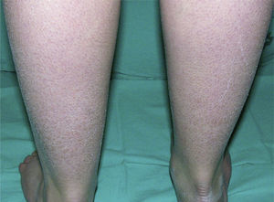 Fine, pale desquamation in a patient with ichthyosis vulgaris.