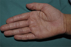 Palmar hyperlinearity in a 7-year-old child with ichthyosis vulgaris.