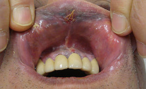 Oral mucosal melanoma.