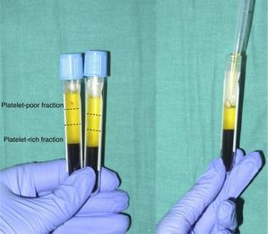 Pipetting the platelet-rich fraction.