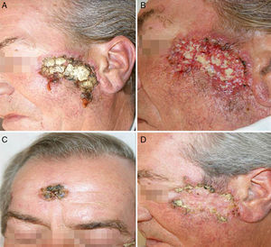 A and B. Appearance of lesions with severe inflammatory reaction, scab formation, and suppuration 1 month after start of tuberculosis treatment. C and D. At 4 months after start of treatment.