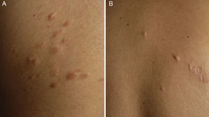 Patient 6. A, Grouped leiomyomas forming a plaque on the upper back. B, Diffuse leiomyomas on the back and a scar from an excised lesion.