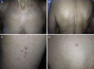 Patient 8. A, Diffuse leiomyomas in the neckline region. B, Diffuse lesions on the back. C, Grouped lesions on the arm. D, Diffuse lesions on the shoulder.