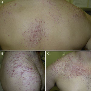 Patient 7. A, Multiple leiomyomas forming plaques on the back and shoulder, in addition to several diffuse lesions. B, Detail showing lesions on the right shoulder. C, Grouped leiomyomas in the supraclavicular area and on the right shoulder.