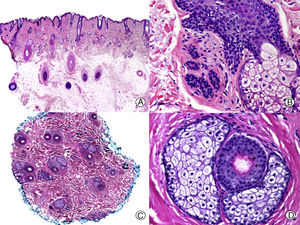 Androgenic alopecia. A, The longitudinal sections show a miniaturization of the terminal follicles, which convert to vellus follicles (hematoxylin-eosin [HE] x 20). B, Miniaturized hair follicles and apparently hypertrophic sebaceous glands (HE x 200). C, Same case studied with transversal sections, with several hair units of smaller size than normal in the scalp (HE x 20). D, Detail of the previous image in which sebaceous glands can be seen with a proportionally greater volume compared to the size of the hair follicles (HE x 200).