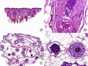 Chemotherapy-induced telogen effluvium. A, Longitudinal sections showing several hair follicles in telogen, surrounded by thick perifollicular connective sheaths (hematoxylin -eosin [HE] x 10). B, Detail of the previous image showing a thick, corrugated vitreous membrane around the telogen club hair (HE x 200). C, Same case studied with transversal sections, with several hair units (HE x 20). D, Detail of the previous image showing a corrugated outer root sheath surrounded by a thick vitreous membrane (HE x 200).