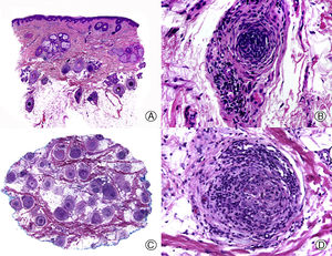 Alopecia areata. A, Longitudinal sections showing an inflammatory infiltrate surrounding the bulbs of the terminal hair follicles (hematoxylin-eosin [HE] x 10). B, Detail of the previous image showing that the inflammatory infiltrate is made up mainly of lymphocytes (HE x 200). C, Transversal sections of the same case showing an inflammatory infiltrate around the inferior segment of several of the hair follicles (HE x 10). D, Detail of the previous image showing an intense lymphocyte infiltrate (HE x 200).
