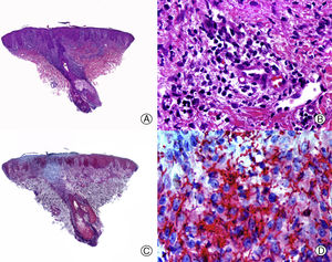 Syphilitic alopecia. A, A lichenoid infiltrate at the dermal-epidermal junction along with a dense perifollicular infiltrate (hematoxylin-eosin [HE] x 10). B. At higher magnification, we see that the infiltrate is made up mainly of lymphocytes and plasma cells (HE x 400). C. Immunohistochemistry of the same case for Treponema pallidum (HE x 10). D. Numerous treponemas between the epithelium of the outer root sheath of the follicle (HE x 400).