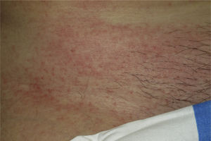 Lesions in the form of erythematous papules and macules on the trunk of a patient with telaprevir-induced grade 1 eruptions.
