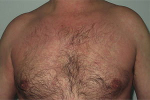 Telaprevir-induced eruption: erythematous lesions on the upper body of a male patient.
