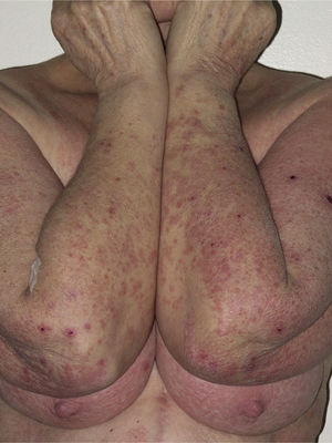 Excoriated erythematous-violaceous plaques on a female patient with telaprevir-induced eruption.