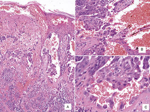 A, Panoramic view of angiomatoid melanoma (hematoxylin-eosin, original magnification ×100). B and C, Higher-magnification view showing the pseudovascular spaces lined with neoplastic cells and numerous extravasated erythrocytes (hematoxylin-eosin, original magnification ×200).