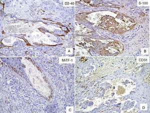 A, Immunohistochemical staining with D2-40 (podoplanin). B, S-100 protein. C, MiTF-1 showing positive results for pseudovascular spaces. D, CD31 showing positive results only for small vessels (negative staining for pseudovascular spaces).