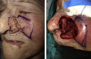 Squamous cell carcinoma in the left nasal ala. A, Lesion prior to surgical excision. B, Surgical defect after excision of the tumor.