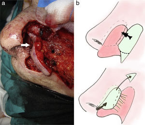 Reconstruction. A, Design of the flap, showing the cut of the subcutaneous pedicle (*) and suture of the turnover island (arrow). B, Schematic of the flap.