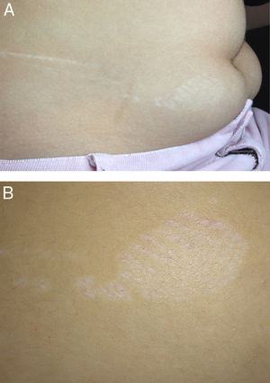 Complete and more detailed frontal view. A, Papular plaques in a linear pattern (17cm) on the right abdomen. B, Whitish atrophied plaque (maximum diameter of 5cm) at the edge of the lesion.
