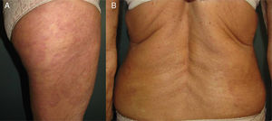 A and B, Right thigh and lumbar region after 27 treatment sessions.
