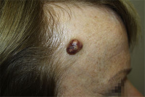 Clinical image showing a multicolor excrescent tumor measuring 15mm across, with a well-defined border in the right frontoparietal region.